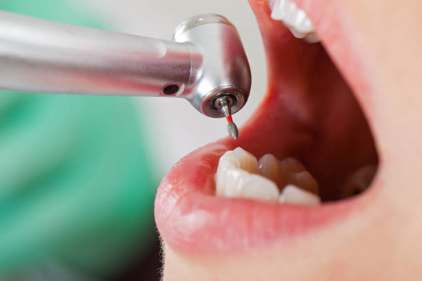 Best Emergency Wisdom Teeth Removal in Herald Harbor, MD
